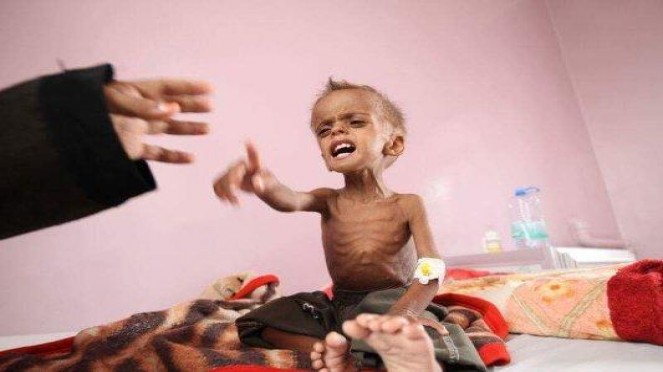 وفاة 10 أطفال يمنيين بسبب ارتفاع درجات الحرارة في الحديدة